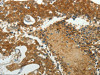 The image on the left is immunohistochemistry of paraffin-embedded Human breast cancer tissue using CSB-PA232265 (MCM4 Antibody) at dilution 1/40, on the right is treated with synthetic peptide. (Original magnification: ×200)