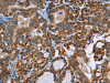 The image on the left is immunohistochemistry of paraffin-embedded Human thyroid cancer tissue using CSB-PA598314 (ABCB1 Antibody) at dilution 1/30, on the right is treated with synthetic peptide. (Original magnification: ×200)