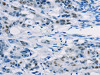 The image on the left is immunohistochemistry of paraffin-embedded Human colon cancer tissue using CSB-PA984353 (ABCC1 Antibody) at dilution 1/20, on the right is treated with synthetic peptide. (Original magnification: ×200)