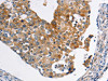 The image on the left is immunohistochemistry of paraffin-embedded Human breast cancer tissue using CSB-PA914467 (ABCC3 Antibody) at dilution 1/20, on the right is treated with synthetic peptide. (Original magnification: ×200)