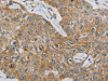 The image on the left is immunohistochemistry of paraffin-embedded Human esophagus cancer tissue using CSB-PA220976 (MMP8 Antibody) at dilution 1/45, on the right is treated with synthetic peptide. (Original magnification: ×200)