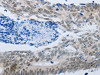 The image on the left is immunohistochemistry of paraffin-embedded Human colon cancer tissue using CSB-PA729577 (MMP21 Antibody) at dilution 1/45, on the right is treated with synthetic peptide. (Original magnification: ×200)
