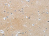 The image on the left is immunohistochemistry of paraffin-embedded Human brain tissue using CSB-PA198245 (MMP25 Antibody) at dilution 1/80, on the right is treated with synthetic peptide. (Original magnification: ×200)