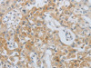 The image on the left is immunohistochemistry of paraffin-embedded Human lung cancer tissue using CSB-PA926432 (MMP25 Antibody) at dilution 1/80, on the right is treated with synthetic peptide. (Original magnification: ×200)