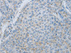 The image on the left is immunohistochemistry of paraffin-embedded Human liver cancer tissue using CSB-PA926432 (MMP25 Antibody) at dilution 1/80, on the right is treated with synthetic peptide. (Original magnification: ×200)