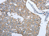 The image on the left is immunohistochemistry of paraffin-embedded Human breast cancer tissue using CSB-PA091551 (MMP19 Antibody) at dilution 1/15, on the right is treated with synthetic peptide. (Original magnification: ×200)