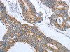 The image on the left is immunohistochemistry of paraffin-embedded Human colon cancer tissue using CSB-PA091551 (MMP19 Antibody) at dilution 1/15, on the right is treated with synthetic peptide. (Original magnification: ×200)