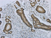 The image on the left is immunohistochemistry of paraffin-embedded Human colorectal cancer tissue using CSB-PA166201 (MMP24 Antibody) at dilution 1/25, on the right is treated with synthetic peptide. (Original magnification: ×200)
