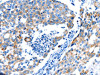 The image on the left is immunohistochemistry of paraffin-embedded Human breast cancer tissue using CSB-PA578328 (POMC Antibody) at dilution 1/30, on the right is treated with synthetic peptide. (Original magnification: ×200)