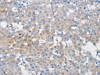 The image on the left is immunohistochemistry of paraffin-embedded Human breast cancer tissue using CSB-PA154128 (MUC5AC Antibody) at dilution 1/80, on the right is treated with synthetic peptide. (Original magnification: ×200)