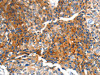 The image on the left is immunohistochemistry of paraffin-embedded Human breast cancer tissue using CSB-PA780156 (MTNR1A Antibody) at dilution 1/100, on the right is treated with synthetic peptide. (Original magnification: ×200)