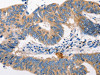 The image on the left is immunohistochemistry of paraffin-embedded Human colon cancer tissue using CSB-PA273227 (MTOR Antibody) at dilution 1/60, on the right is treated with synthetic peptide. (Original magnification: ×200)