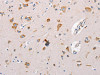 The image on the left is immunohistochemistry of paraffin-embedded Human brain tissue using CSB-PA273227 (MTOR Antibody) at dilution 1/60, on the right is treated with synthetic peptide. (Original magnification: ×200)