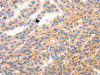 The image on the left is immunohistochemistry of paraffin-embedded Human ovarian cancer tissue using CSB-PA926395 (MYL9 Antibody) at dilution 1/80, on the right is treated with synthetic peptide. (Original magnification: ×200)