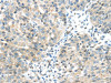 The image on the left is immunohistochemistry of paraffin-embedded Human breast cancer tissue using CSB-PA169699 (CHRNA1 Antibody) at dilution 1/20, on the right is treated with synthetic peptide. (Original magnification: ×200)