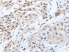 The image on the left is immunohistochemistry of paraffin-embedded Human lung cancer tissue using CSB-PA968134 (CHRNA10 Antibody) at dilution 1/50, on the right is treated with synthetic peptide. (Original magnification: ×200)