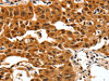 The image on the left is immunohistochemistry of paraffin-embedded Human lung cancer tissue using CSB-PA179192 (YWHAB Antibody) at dilution 1/30, on the right is treated with synthetic peptide. (Original magnification: ×200)