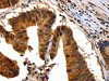 The image on the left is immunohistochemistry of paraffin-embedded Human colon cancer tissue using CSB-PA179192 (YWHAB Antibody) at dilution 1/30, on the right is treated with synthetic peptide. (Original magnification: ×200)