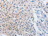 The image on the left is immunohistochemistry of paraffin-embedded Human lung cancer tissue using CSB-PA184783 (YWHAQ Antibody) at dilution 1/50, on the right is treated with synthetic peptide. (Original magnification: ×200)