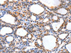 The image on the left is immunohistochemistry of paraffin-embedded Human thyroid cancer tissue using CSB-PA234560 (YWHAQ Antibody) at dilution 1/20, on the right is treated with synthetic peptide. (Original magnification: ×200)