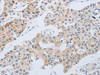 The image on the left is immunohistochemistry of paraffin-embedded Human lung cancer tissue using CSB-PA170330 (NBN Antibody) at dilution 1/30, on the right is treated with synthetic peptide. (Original magnification: ×200)