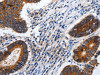 The image on the left is immunohistochemistry of paraffin-embedded Human colon cancer tissue using CSB-PA164023 (CDH1 Antibody) at dilution 1/100, on the right is treated with synthetic peptide. (Original magnification: ×200)