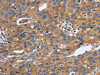 The image on the left is immunohistochemistry of paraffin-embedded Human ovarian cancer tissue using CSB-PA164023 (CDH1 Antibody) at dilution 1/100, on the right is treated with synthetic peptide. (Original magnification: ×200)