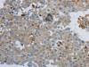 The image on the left is immunohistochemistry of paraffin-embedded Human breast cancer tissue using CSB-PA247166 (CKMT1A/CKMT1B Antibody) at dilution 1/100, on the right is treated with synthetic peptide. (Original magnification: ×200)