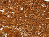 The image on the left is immunohistochemistry of paraffin-embedded Human cervical cancer tissue using CSB-PA936378 (NCOR1 Antibody) at dilution 1/60, on the right is treated with synthetic peptide. (Original magnification: ×200) The image on the left is immunohistochemistry of paraffin-embedded Human cervical cancer tissue using CSB-PA936378 (NCOR1 Antibody) at dilution 1/60, on the right is treated with synthetic peptide. (Original magnification: ×200)