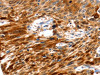 The image on the left is immunohistochemistry of paraffin-embedded Human esophagus cancer tissue using CSB-PA936378 (NCOR1 Antibody) at dilution 1/60, on the right is treated with synthetic peptide. (Original magnification: ×200)