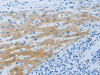 The image on the left is immunohistochemistry of paraffin-embedded Human liver cancer tissue using CSB-PA909441 (NPHS1 Antibody) at dilution 1/50, on the right is treated with synthetic peptide. (Original magnification: ×200)