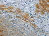 The image on the left is immunohistochemistry of paraffin-embedded Human liver cancer tissue using CSB-PA967591 (NPHS1 Antibody) at dilution 1/40, on the right is treated with synthetic peptide. (Original magnification: ×200)
