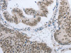 The image on the left is immunohistochemistry of paraffin-embedded Human colon cancer tissue using CSB-PA145524 (AKAP8 Antibody) at dilution 1/15, on the right is treated with synthetic peptide. (Original magnification: ×200)