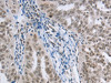 The image on the left is immunohistochemistry of paraffin-embedded Human ovarian cancer tissue using CSB-PA145524 (AKAP8 Antibody) at dilution 1/15, on the right is treated with synthetic peptide. (Original magnification: ×200)