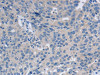 The image on the left is immunohistochemistry of paraffin-embedded Human ovarian cancer tissue using CSB-PA283513 (GRIN1 Antibody) at dilution 1/50, on the right is treated with synthetic peptide. (Original magnification: ×200)