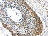 The image on the left is immunohistochemistry of paraffin-embedded Human esophagus cancer tissue using CSB-PA240091 (GRIN2A Antibody) at dilution 1/30, on the right is treated with synthetic peptide. (Original magnification: ×200)
