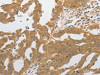 The image on the left is immunohistochemistry of paraffin-embedded Human ovarian cancer tissue using CSB-PA583461 (GRIN2C Antibody) at dilution 1/80, on the right is treated with synthetic peptide. (Original magnification: ×200)