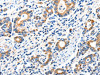 The image on the left is immunohistochemistry of paraffin-embedded Human gastic cancer tissue using CSB-PA099037 (GRIA2 Antibody) at dilution 1/40, on the right is treated with synthetic peptide. (Original magnification: ×200)