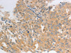 The image on the left is immunohistochemistry of paraffin-embedded Human ovarian cancer tissue using CSB-PA562577 (HCRTR2 Antibody) at dilution 1/50, on the right is treated with synthetic peptide. (Original magnification: ×200)