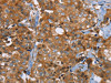 The image on the left is immunohistochemistry of paraffin-embedded Human breast cancer tissue using CSB-PA548912 (P2RY1 Antibody) at dilution 1/40, on the right is treated with synthetic peptide. (Original magnification: ×200)
