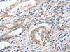 The image on the left is immunohistochemistry of paraffin-embedded Human gastic cancer tissue using CSB-PA582272 (P2RY11 Antibody) at dilution 1/40, on the right is treated with synthetic peptide. (Original magnification: ×200)