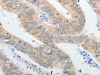 The image on the left is immunohistochemistry of paraffin-embedded Human colon cancer tissue using CSB-PA918814 (PPAP2A Antibody) at dilution 1/40, on the right is treated with synthetic peptide. (Original magnification: ×200)
