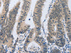 The image on the left is immunohistochemistry of paraffin-embedded Human colon cancer tissue using CSB-PA267410 (F2R Antibody) at dilution 1/40, on the right is treated with synthetic peptide. (Original magnification: ×200)