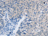 The image on the left is immunohistochemistry of paraffin-embedded Human ovarian cancer tissue using CSB-PA267410 (F2R Antibody) at dilution 1/40, on the right is treated with synthetic peptide. (Original magnification: ×200)