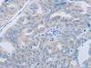 The image on the left is immunohistochemistry of paraffin-embedded Human ovarian cancer tissue using CSB-PA225945 (PAWR Antibody) at dilution 1/60, on the right is treated with synthetic peptide. (Original magnification: ×200)