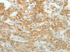 The image on the left is immunohistochemistry of paraffin-embedded Human lung cancer tissue using CSB-PA295467 (PAX5 Antibody) at dilution 1/20, on the right is treated with synthetic peptide. (Original magnification: ×200)