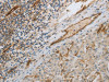 The image on the left is immunohistochemistry of paraffin-embedded Human liver cancer tissue using CSB-PA982317 (PECAM1 Antibody) at dilution 1/30, on the right is treated with synthetic peptide. (Original magnification: ×200)