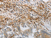 The image on the left is immunohistochemistry of paraffin-embedded Human colon cancer tissue using CSB-PA085447 (PECAM1 Antibody) at dilution 1/30, on the right is treated with synthetic peptide. (Original magnification: ×200)