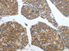 The image on the left is immunohistochemistry of paraffin-embedded Human liver cancer tissue using CSB-PA656448 (PDK2 Antibody) at dilution 1/40, on the right is treated with synthetic peptide. (Original magnification: ×200)
