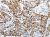 The image on the left is immunohistochemistry of paraffin-embedded Human lung cancer tissue using CSB-PA656448 (PDK2 Antibody) at dilution 1/40, on the right is treated with synthetic peptide. (Original magnification: ×200)